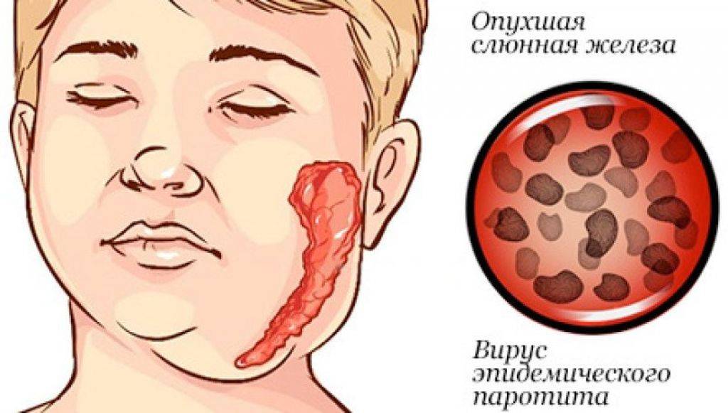 Эпидемический паротит (свинка)