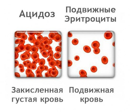 Ацидоз