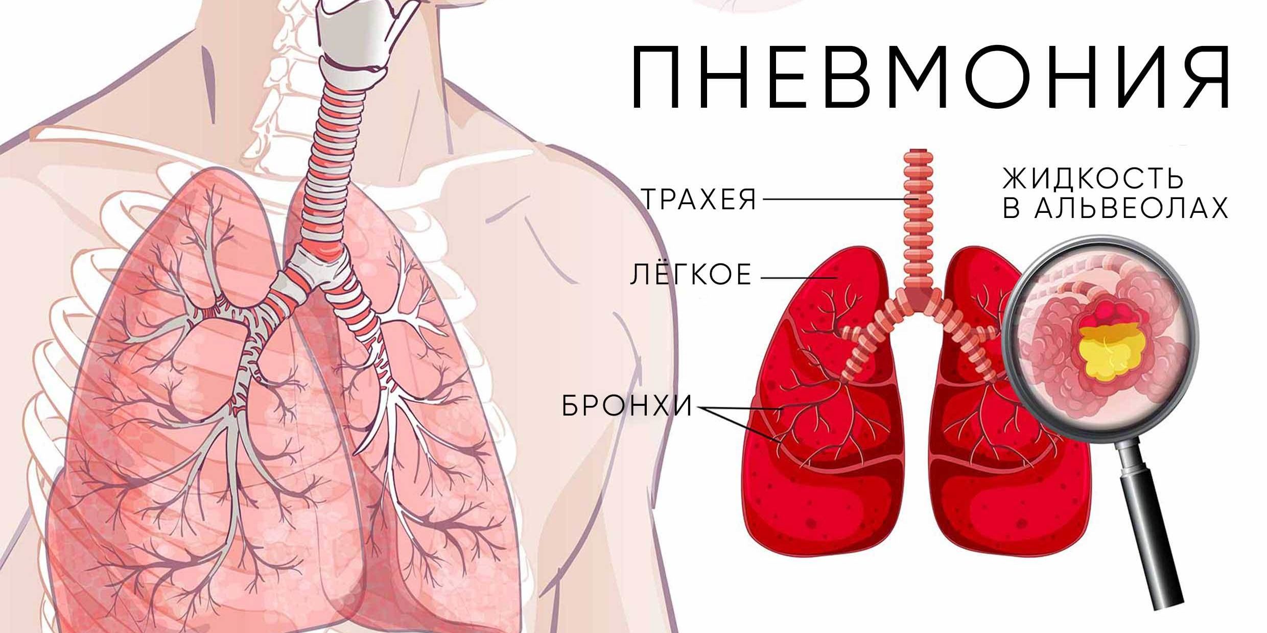 Пневмония у взрослых