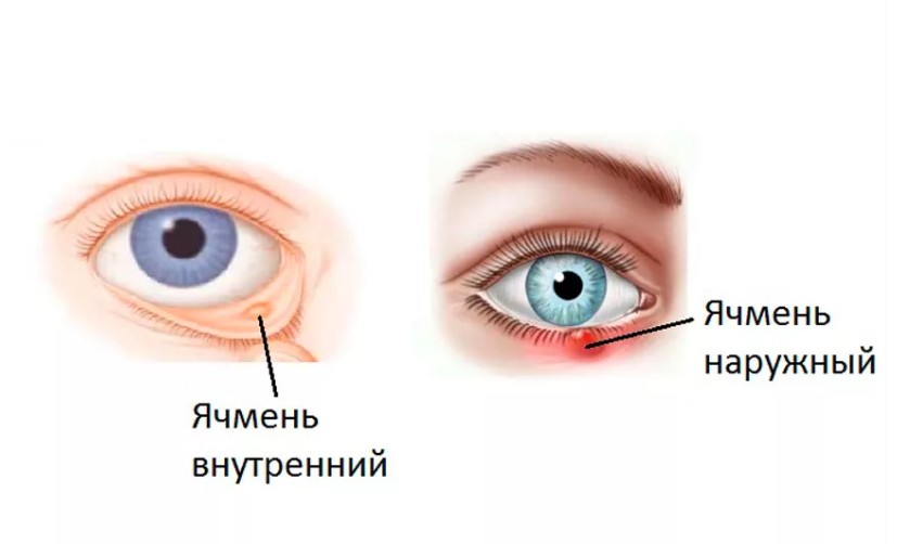 Можно ли «спрятать» ячмень?