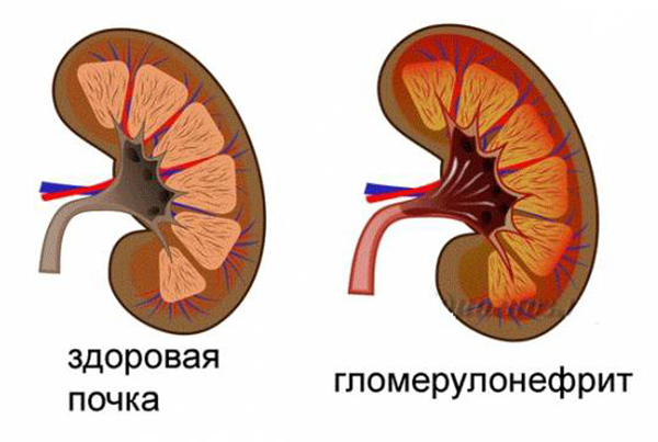 Гломерулонефрит
