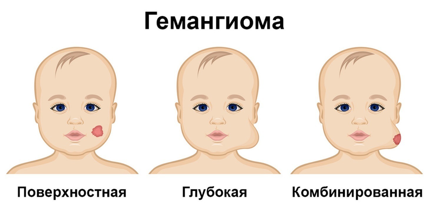 Гемангиома у новорожденных