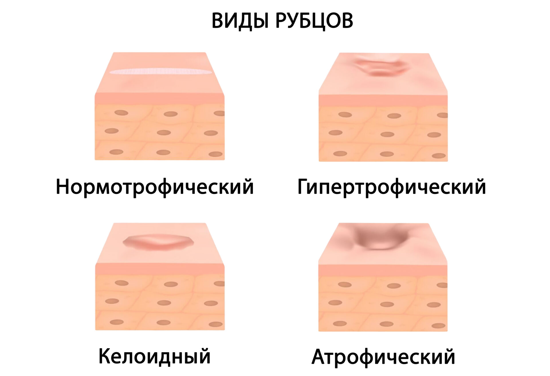 Келоидные рубцы