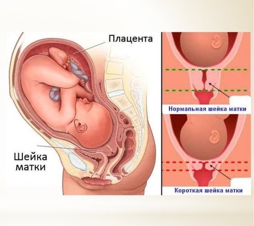 Истмико-цервикальная недостаточность (ИЦН)