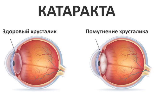 Как предупредить развитие катаракты