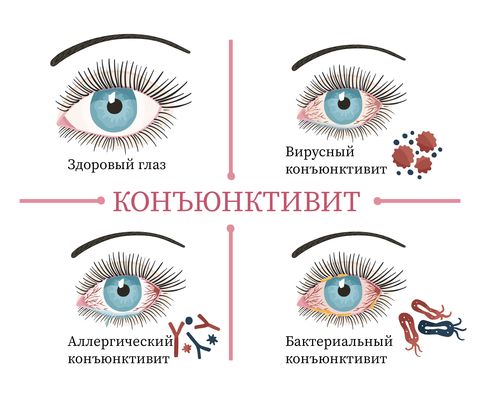 Коньюктивит