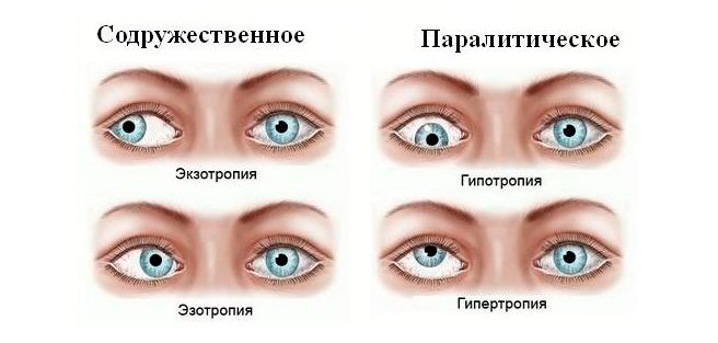 Косоглазие
