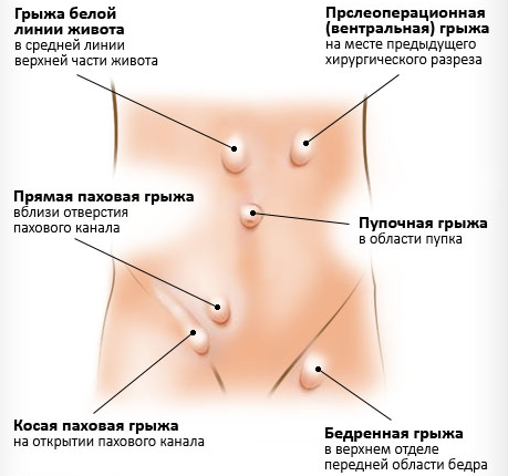 Брюшные грыжи