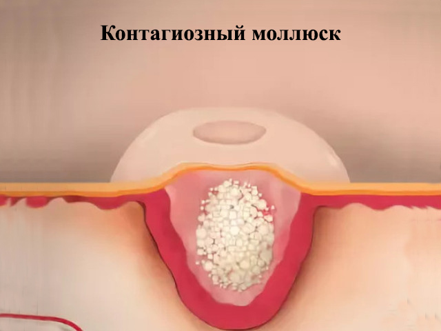 Контагиозный моллюск