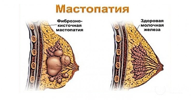 Мастопатия
