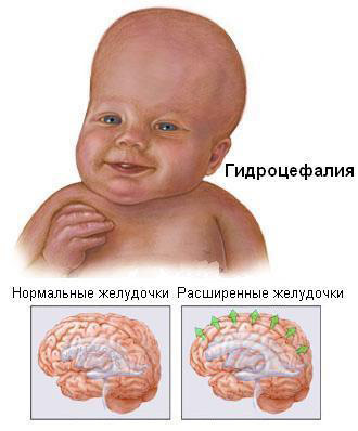 Гидроцефалия у детей