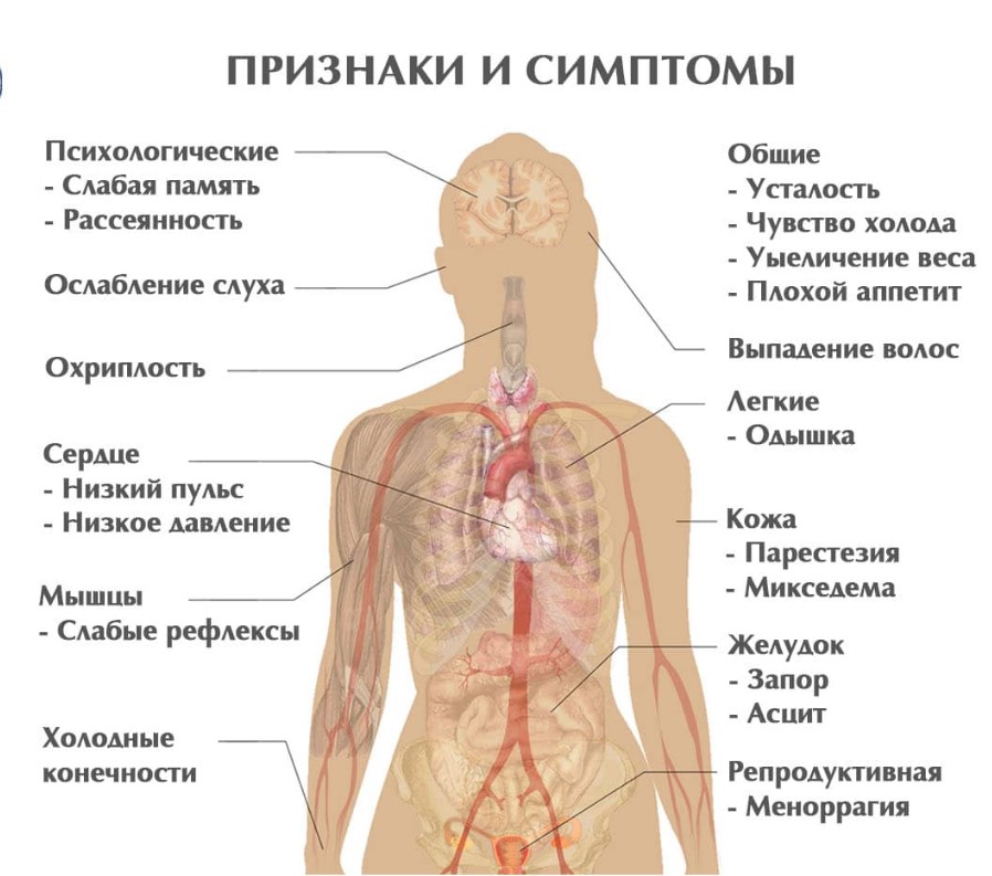 Гипотиреоз