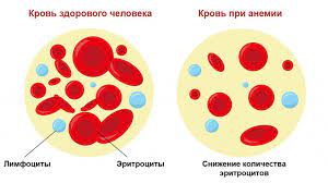 Анемия