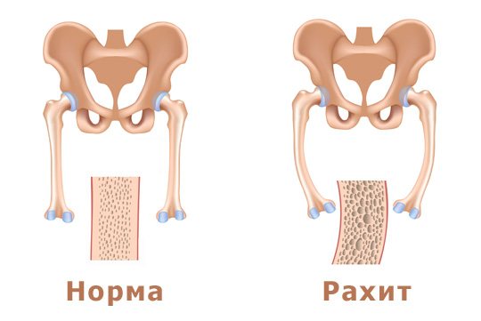 Рахит