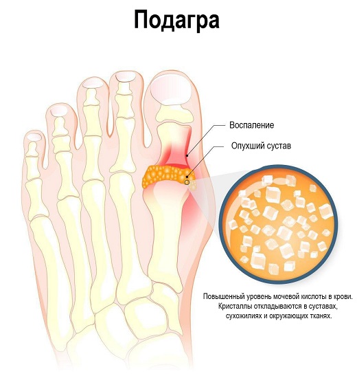 Подагра